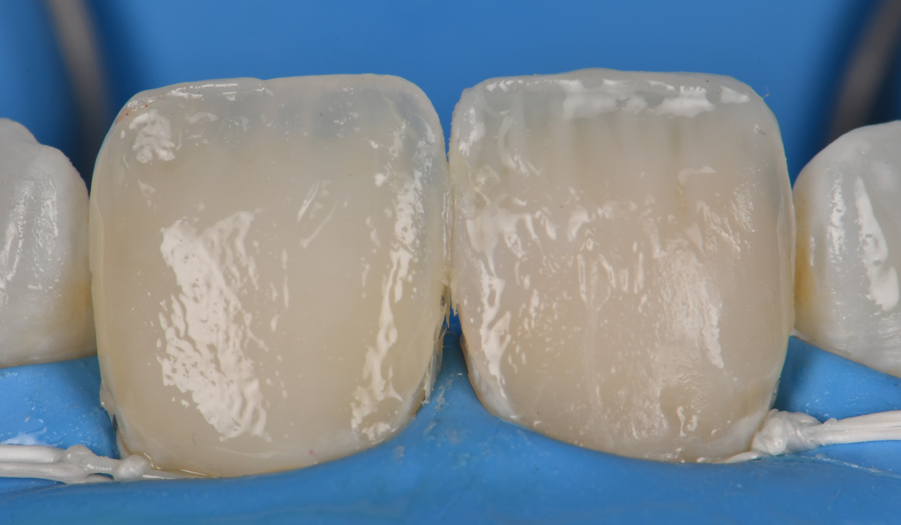 Figure 3: Both horizontal and vertical dentin composite increments are demonstrated mimicking the contralateral tooth.